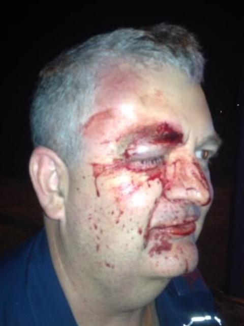 Bashed paramedic Brad Johnson soon after the attack at the hands of a patient.