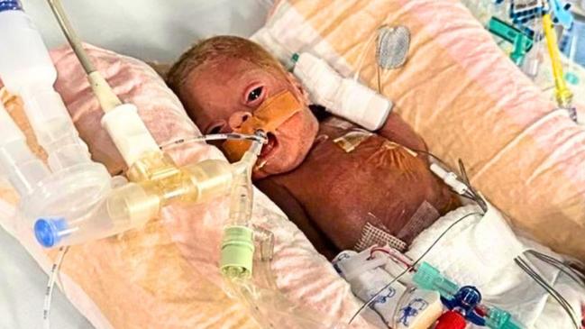 This baby was 14 weeks early… You won’t believe her today