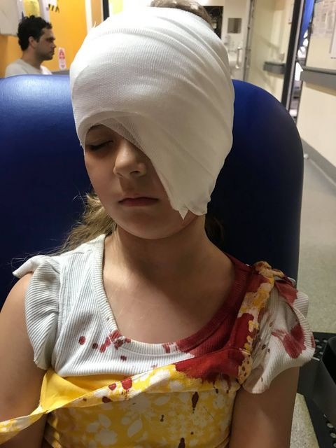 Savana Pierce, 6, suffered horrific injuries to her face when she was struck by a ceiling fan.