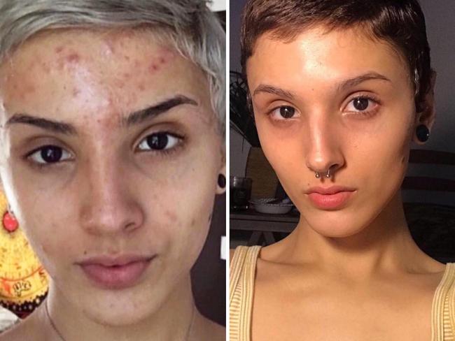 Acne Treatment Woman Cures Severe Acne Spots With Simple Trick News