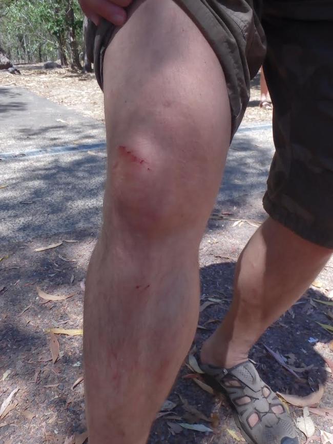 The Russian tourist’s croc bite mark