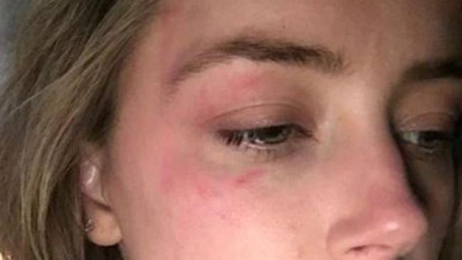 Amber Heard bruised after alleged abuse by Johnny Depp.