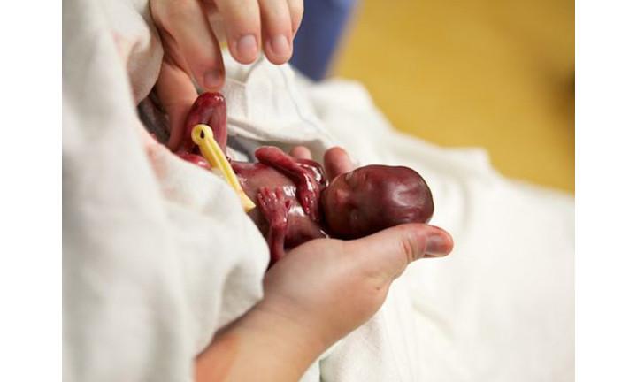 Walter was born at 19 weeks gestation. Here he is cradled in his mum's hands.