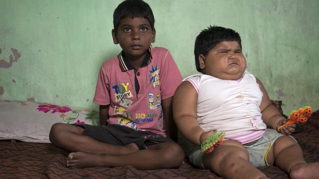 Obese toddler weighing 24kg may have rare condition causing her to ...