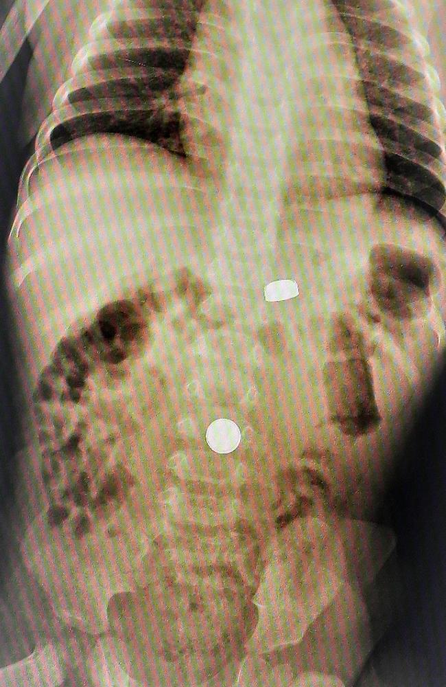 X-ray of a Brisbane child that had swallowed some button batteries. Picture: Liam Kidston.