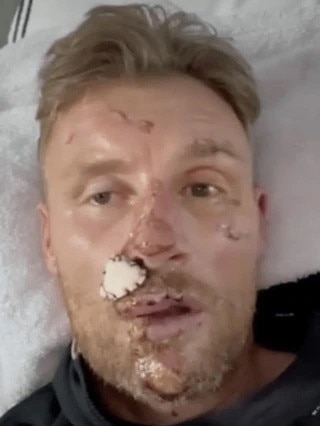 Freddie Flintoff's injuries after the crash. Picture: BBC1