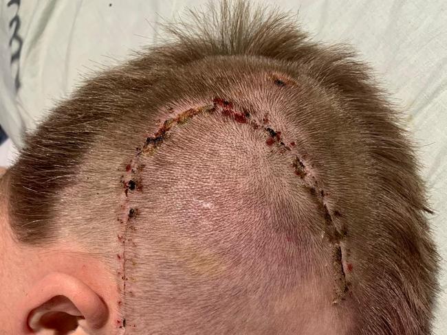 Harry Frolling bears the scars of surgery to repair his fractured skull and alleviate bleeding on the brain. Picture: Shane Froling/Twitter