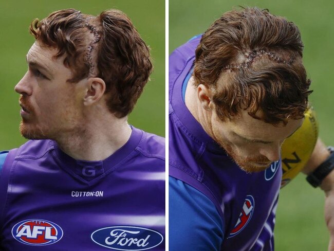 Gary Rohan after the surgery on his skull. Photos: Michael Klein