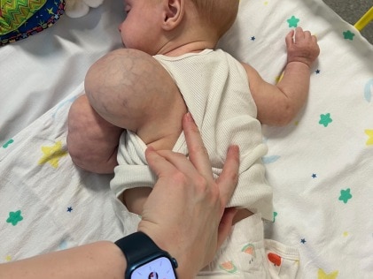 Tobias was born with tumours on his left arm and shoulder. Picture: Supplied