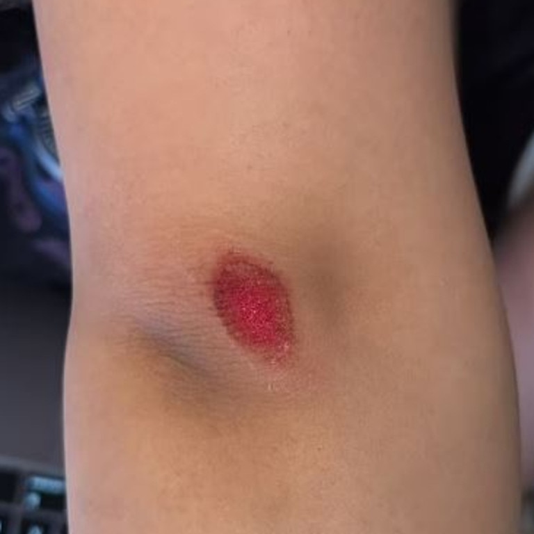 The girls’ father shared a photo of the carpet burn injury. Picture: Supplied