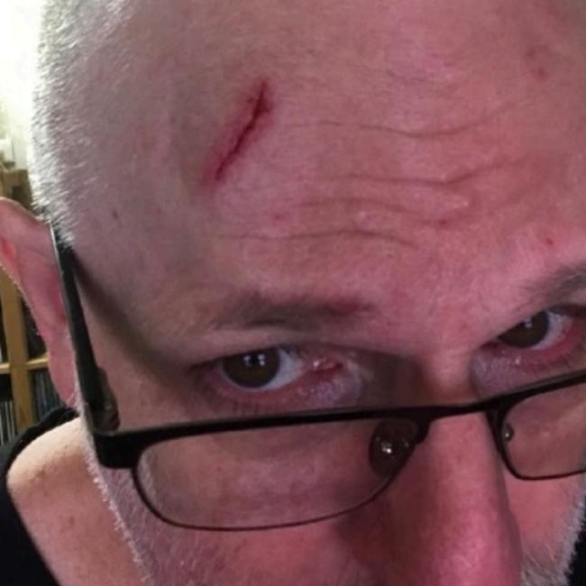 Bellenden Ker man Antony Roth copped a nasty head wound after a rental car door swung shut while he was at the service station. Picture: Supplied