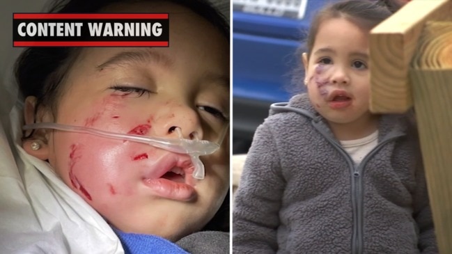 Girl, 3, cheek torn apart by pit bull (ABC 13)