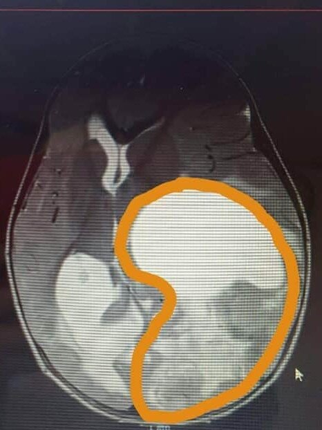 The huge tumour in an MRI.