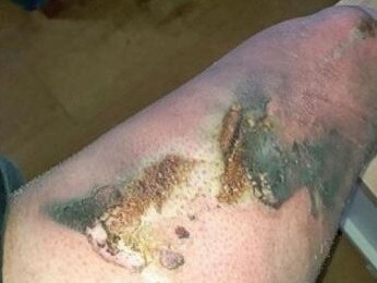 A mine worker suffered serious thermal and chemical burns to his leg when a vape battery combusted while he was travelling in a ute.