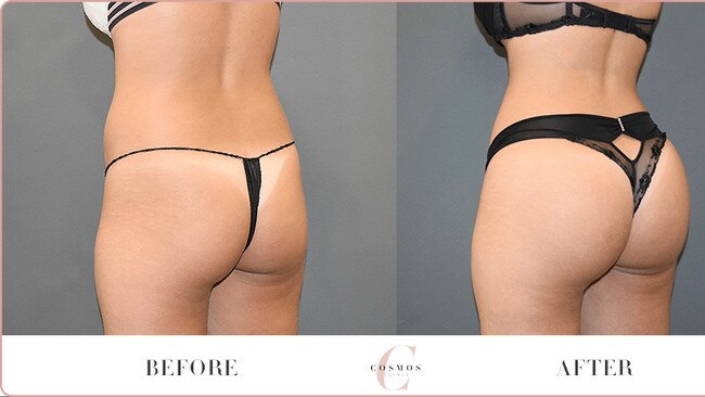 Before and after Brazilian butt lift photos on the Cosmos Clinic website. Picture: Supplied