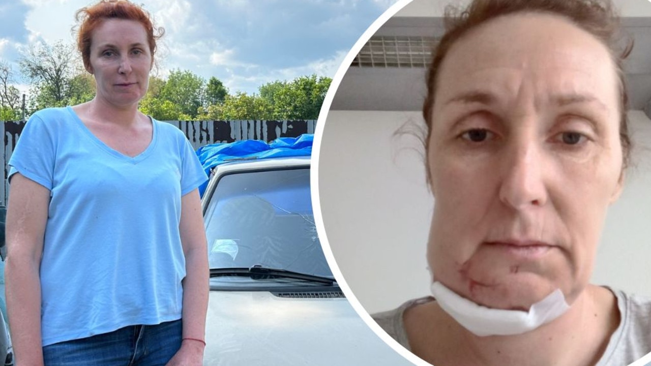 ‘Blood everywhere’: Ukrainian mother recalls horror of being shot in the face