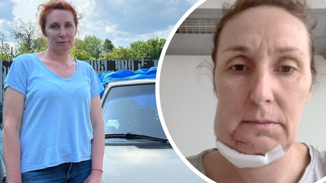 Ukrainian mother-of-two Oksana Serhiienko tells how she was shot in the face by Russian soldiers.