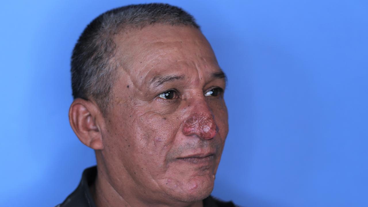 Conrado Estrada was like a new man after his facial surgery. Picture: Supplied.