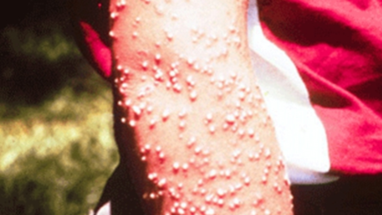 A person bitten by fire ants. Picture: Invasive Species Council