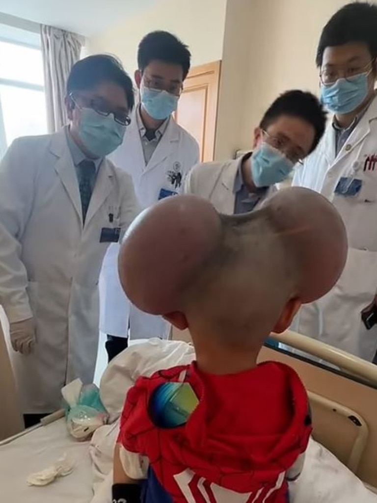 Swelling caused by a skin condition lead to large bumps on both sides of his head. Picture: AsiaWire