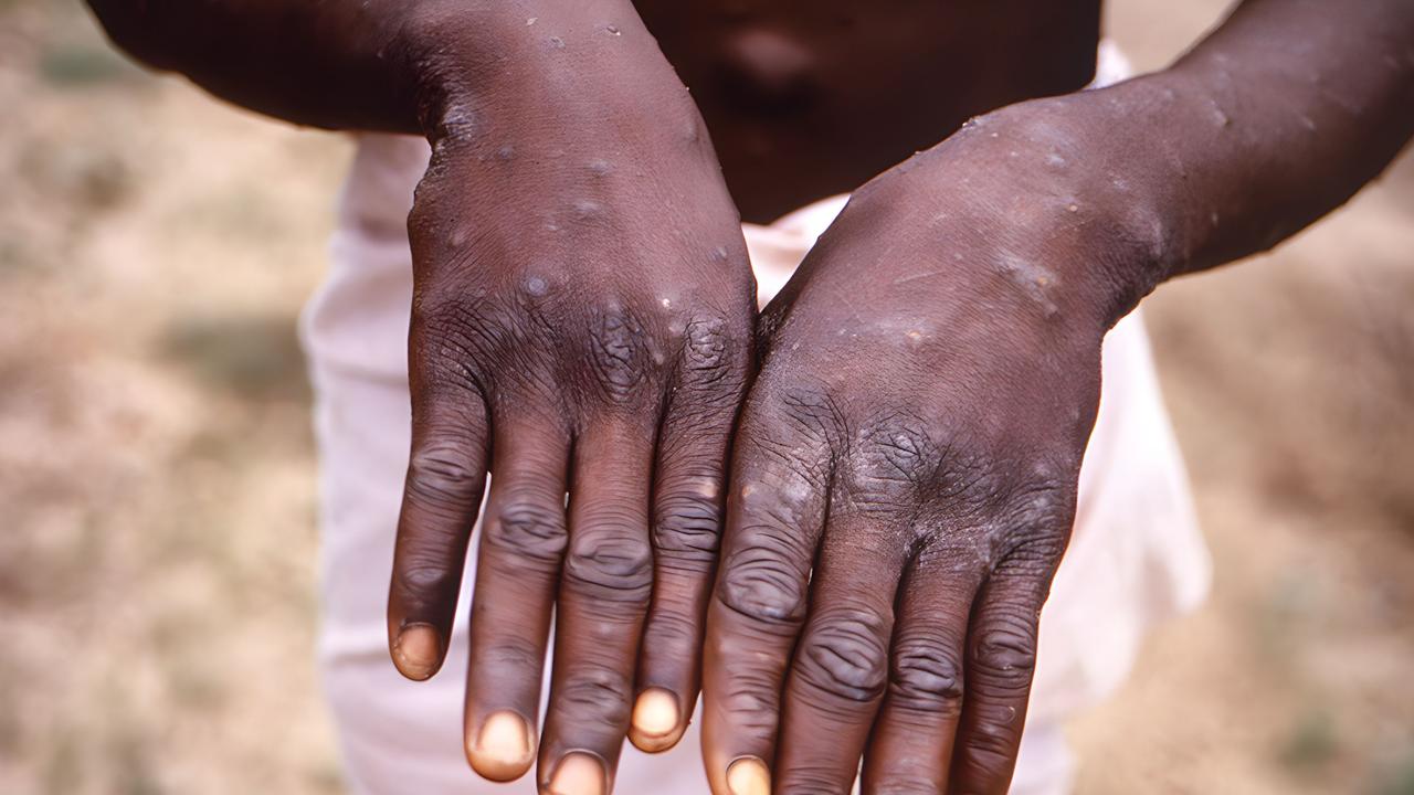 Mpox causes a bumpy rash. Picture: CDC/IMAGE POINT FR/BSIP/Universal Images Group via Getty Images