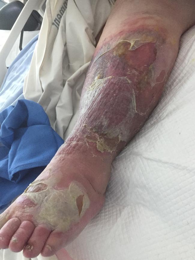 Kaylene Cooper was forced to sleep on an airport couch with severe cellulitis. Picture: Supplied