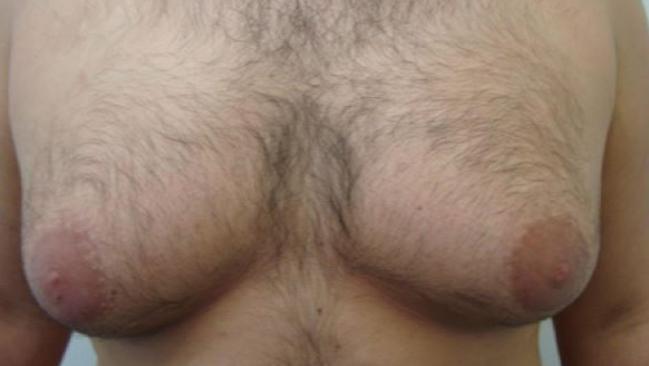 Before and after ‘man boob’ surgery.                        Ariel Winter Looks Amazing After Undergoing Breast Reduction