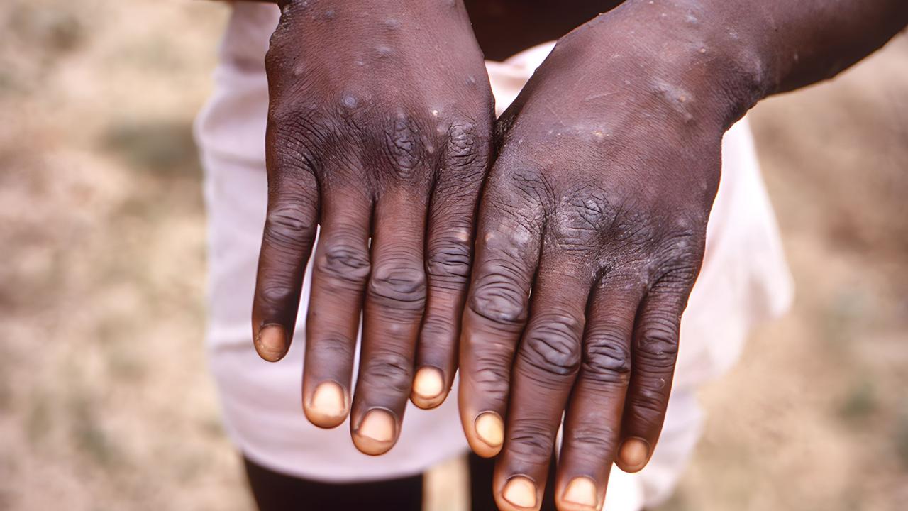 The DRC is already one of 20 African countries suffering a mpox epidemic. Picture: CDC/Image Point FR/Universal Images Group via Getty Images