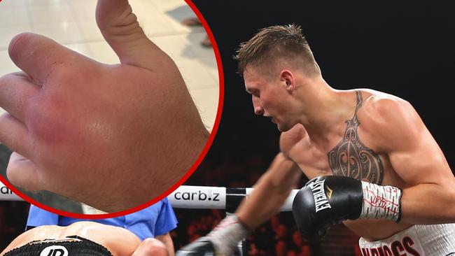 Dylan Biggs went into the fight with an already broken hand.