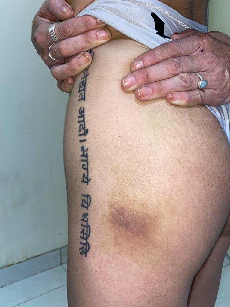 Melbourne DJ Courtney Mills reveals brutal Bali injuries NT News