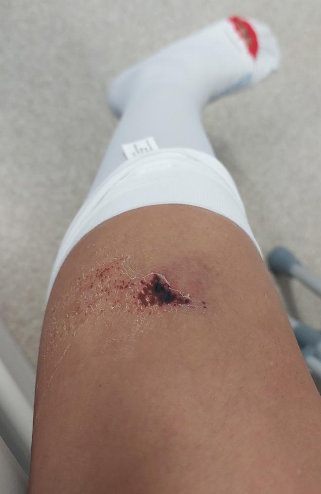 Injuries sustained by Mitchell Barry Sullivan's drink-driving victim. Picture: Supplied