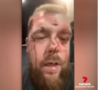 The man assaulted by AFL star Noah Balta is seen with multiple facial injuries in recently released footage. Picture: Channel 7/Seven News