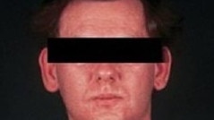 A person with measles.
