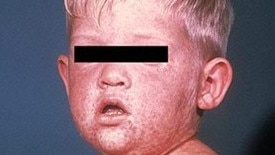 Health authorities have issued a warning to residents after a traveller with a highly infectious disease was detected in a major city. NSW Health was notified of a traveller with a confirmed case of measles who took an international flight to Sydney and visited several locations in the city. The person returned from South-East Asia, which are currently reporting measles outbreaks, incuding Thailand, Vietnam, and Indonesia.