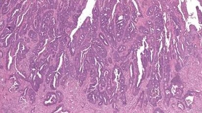 Invasive bowel cancer as seen through a microscope.