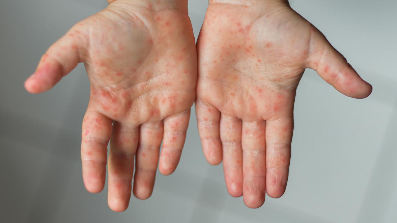 The symptoms of the mysterious condition include rashes. Picture: iStock