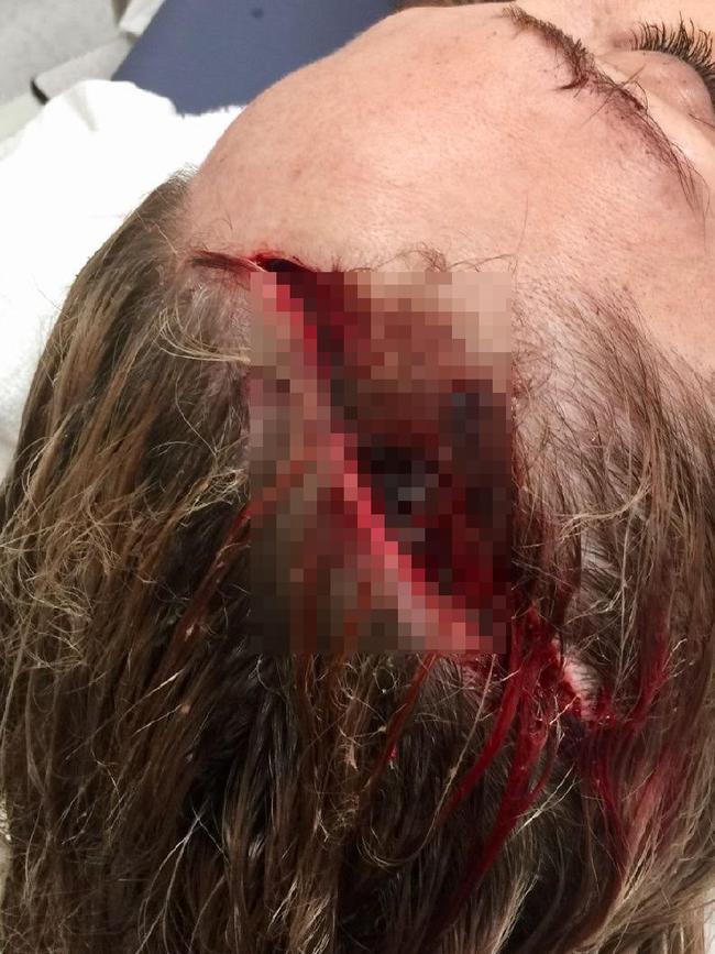 A female youth justice worker after she was "scalped" by a teen thug at Malmsbury Youth Justice Precinct. Picture: Supplied