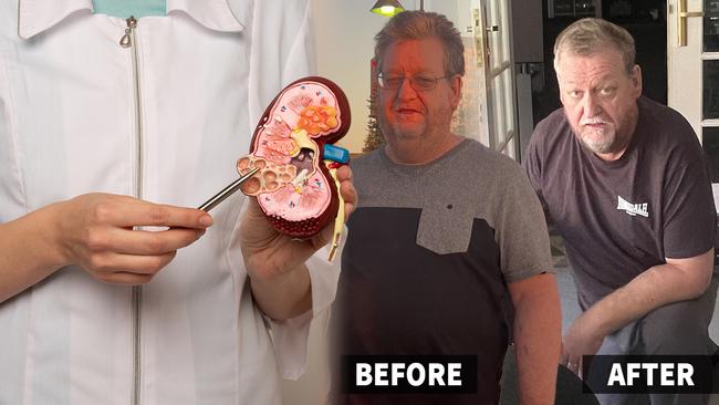 Kidney transplant one for story on weight loss drugs