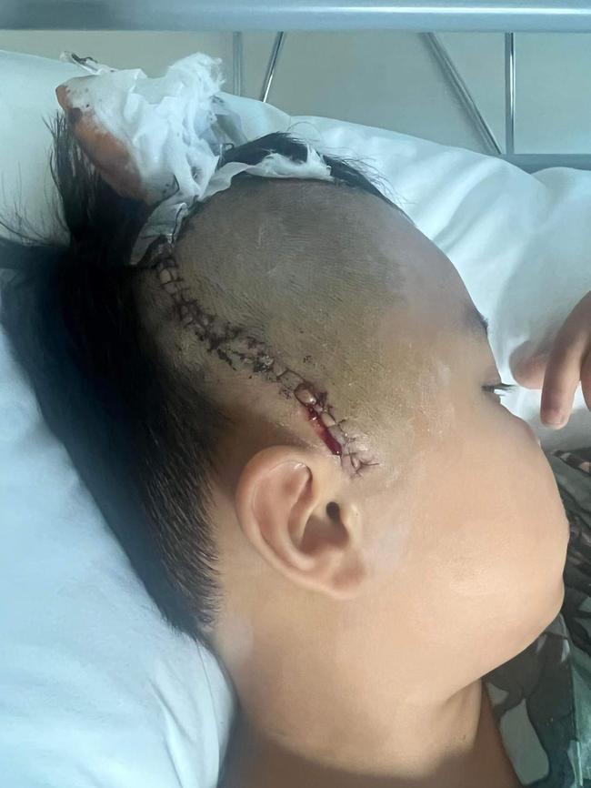 Jayden underwent surgery for bleeding on the brain.