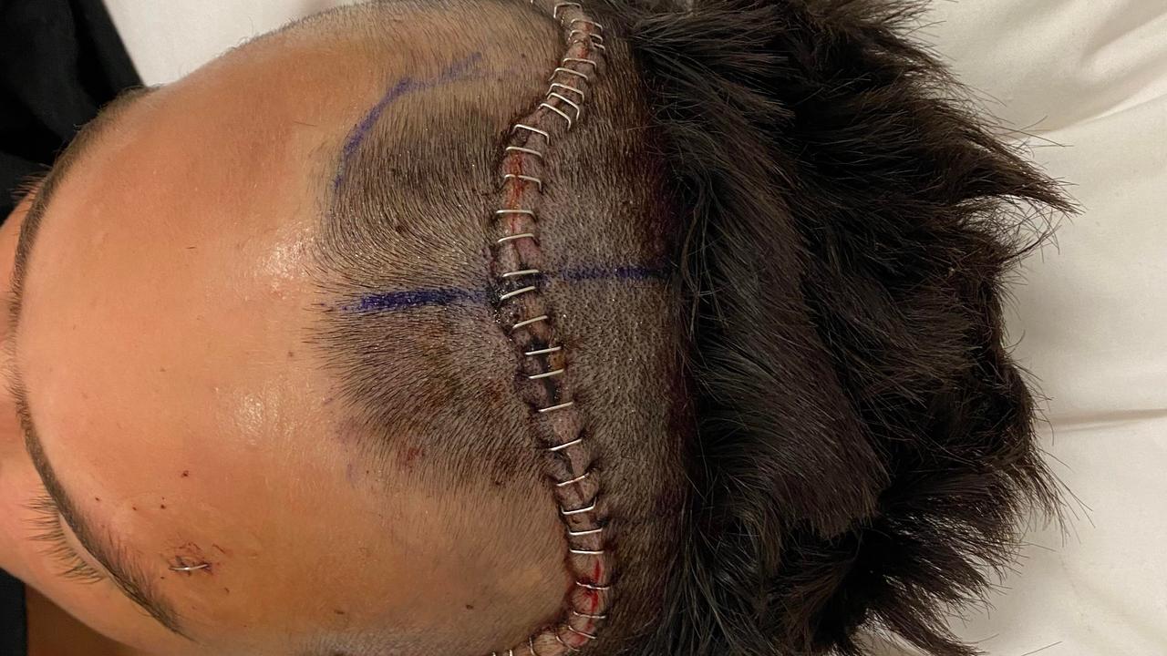 His whole scalp was pulled back during the procedure so it could be removed safely. Picture: Supplied