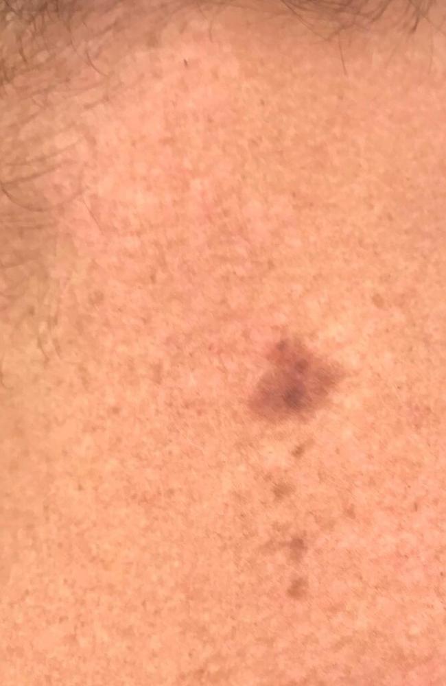 Results later showed he had a skin condition called nevus spilus that transitioned into melanoma. Picture: Facebook / A Little Beauty