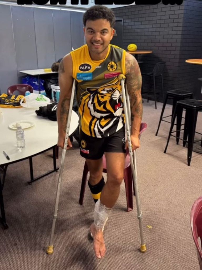 Guy Sebastian finished with a busted Achilles. Photo: Instagram.