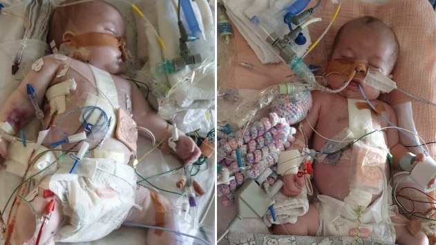 Phoebe Burke is slowly emerging from 15 months in and out of surgery, as she battles the number one killer of Aussie infants under one, CoHD.