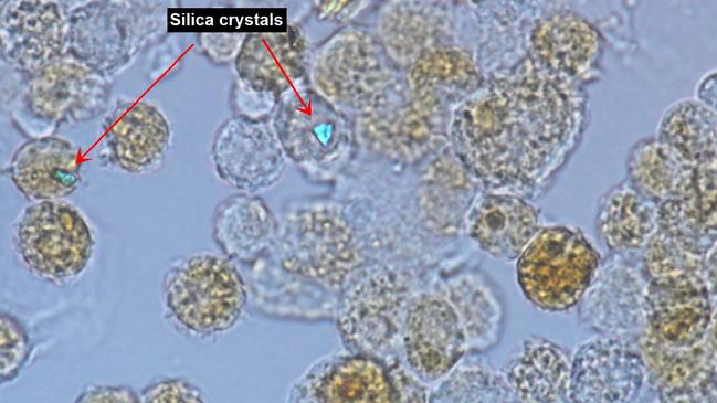 A photo taken from a research lab at The Prince Charles Hospital in Brisbane where University Queensland scientists funded by The Common Good have made a medical breakthrough with a potential cure for potentially deadly silicosis. Pictured here is a highly magnified view of cells taken from a silicosis patient’s lung showing silica crystals embedded in the cells. Supplied