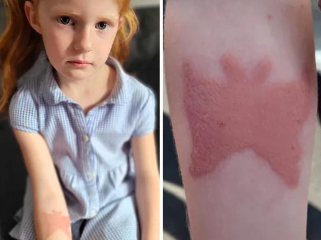 Matilda's henna burn. Picture: Facebook.