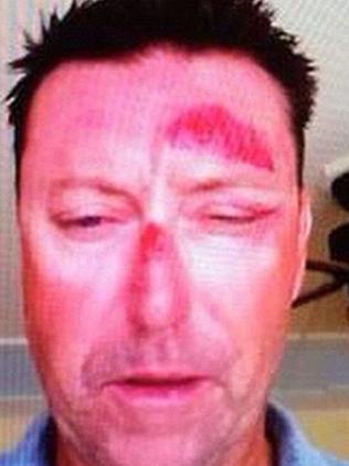This photo of Robert Allenby was posted online after he claimed he was bashed and kidnapped from a bar in Hawaii in January 2015. Picture: Supplied.