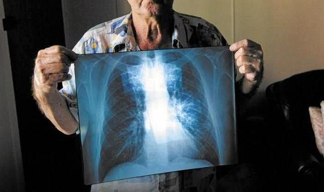 BLACK LUNG: The Queensland State Government have started a register for dust lung diseases. Picture: Contributed