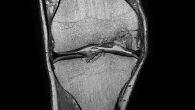 Patient in the trial, Ollie Thursfield's damaged knee after stem cells.