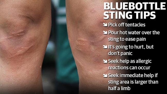 Signs of Bluebottle Stings and What to Do