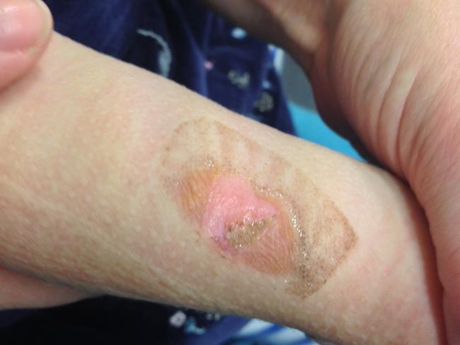 Caitlin Brennan, 1, was burned by liquid from the family's Thermomix in 2014. Picture: Supplied